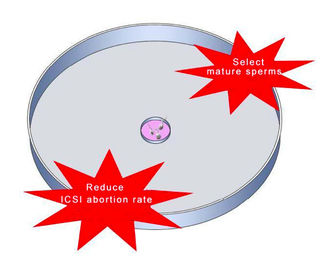 ICSI IVFのためのHyaluronic酸の精液の選択の皿は妊娠の損失率を減らします